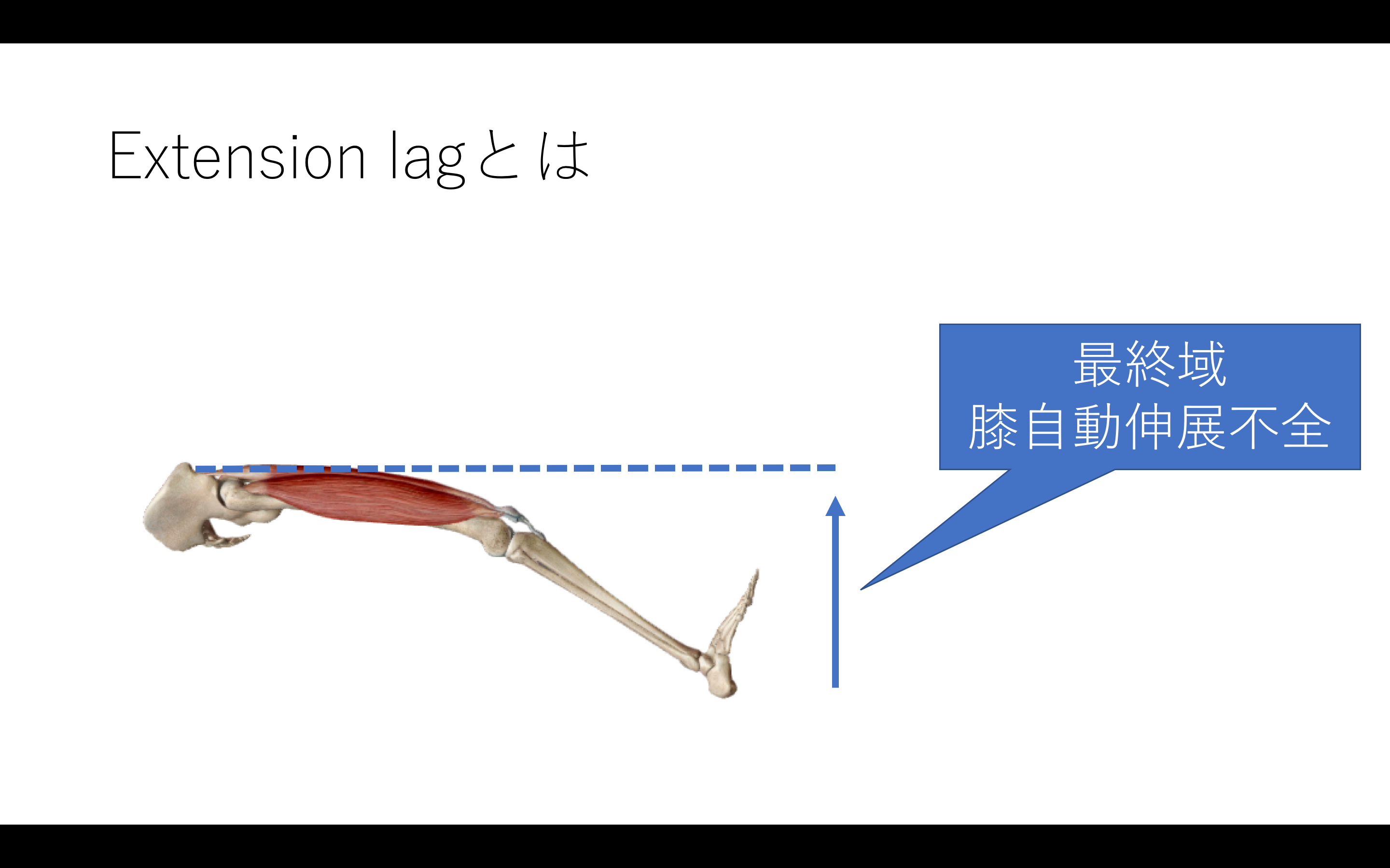 extension lagの原因は内側広筋だけじゃない？膝関節伸展機構のまとめ！ 理学療法士のカラダブログ